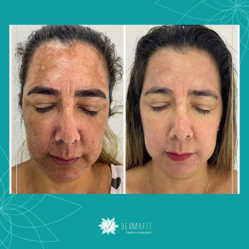 melasma