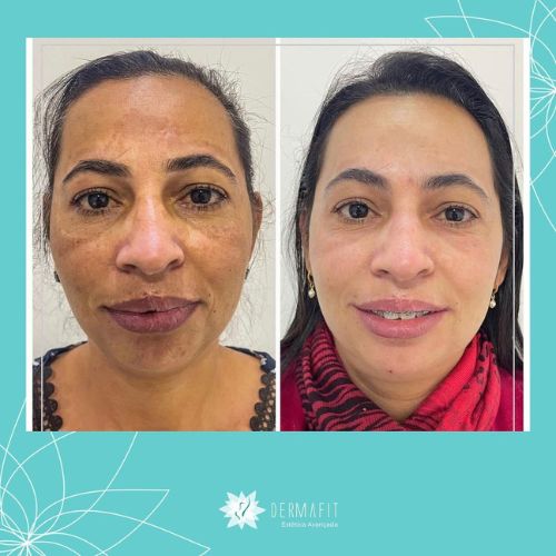 melasma