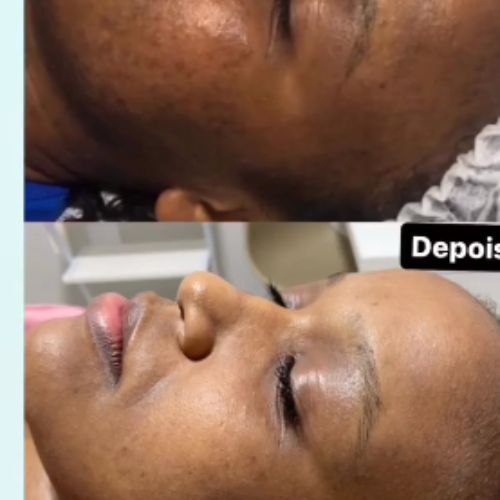 melasma