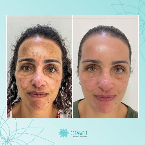 melasma