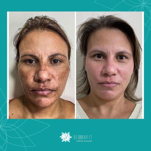melasma