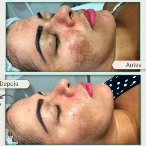 melasma