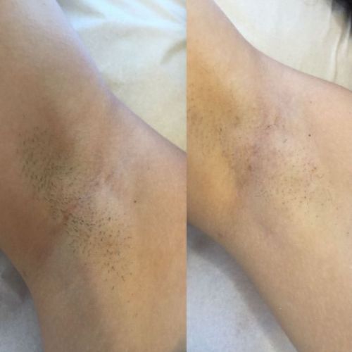 Resultado em apenas uma sessão