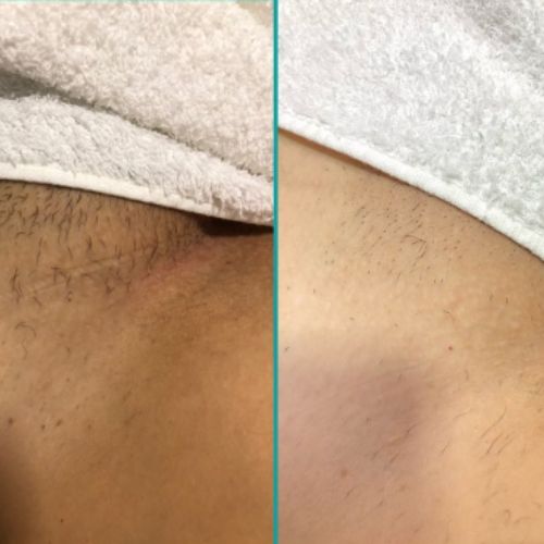 Resultado em apenas uma sessão