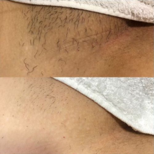 Resultado em apenas uma sessão