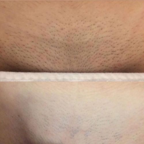 Resultado em apenas uma sessão