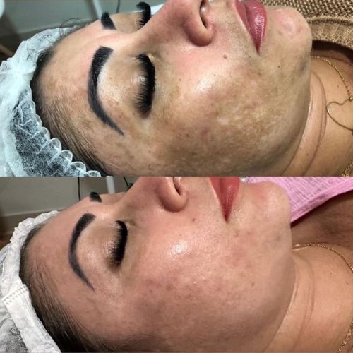 melasma