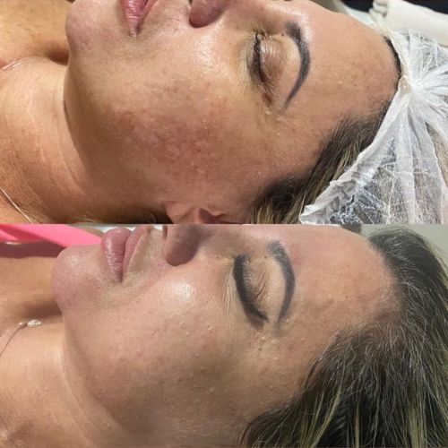 melasma