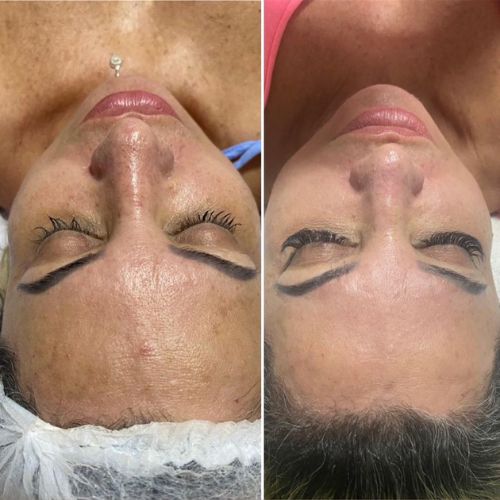 melasma