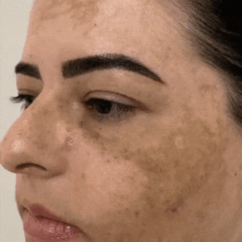 melasma