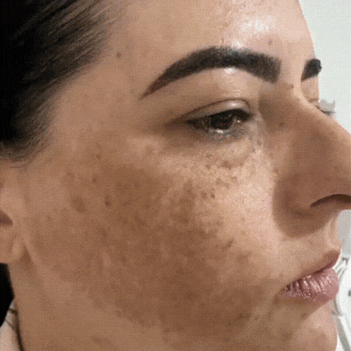 melasma