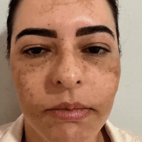 melasma